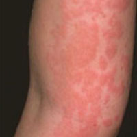 Urticaria